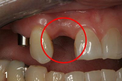 Gum bone is depressed after extraction