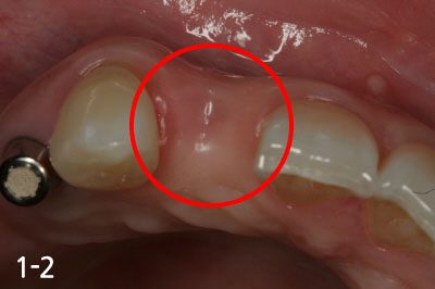 Gum bone is depressed after extraction
