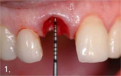 Placing implant right after extraction