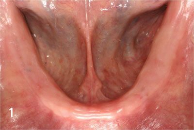 Totally edentulous status on lower jaw