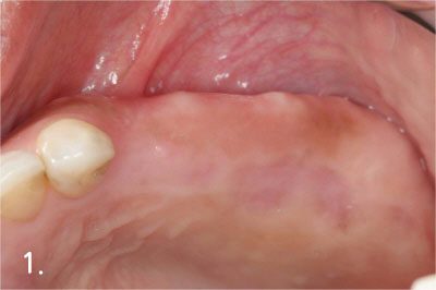 Before the surgery. There is no incision to place implant