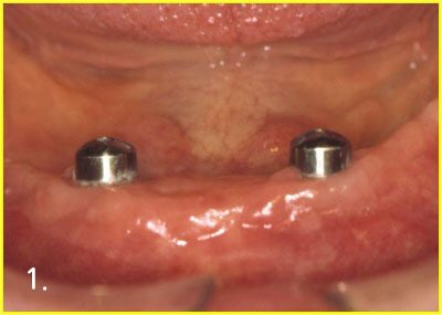 Placing implant for over-denture