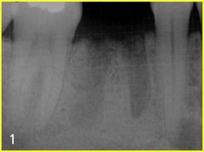 Set up surgical plan with x-ray