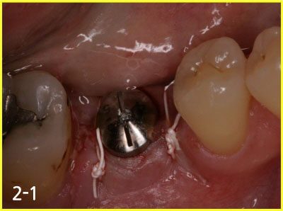 Placing implant