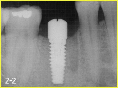 taking X-ray to secure safe implant surgery