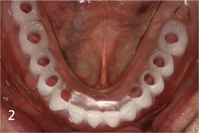 Fit surgical guide for precise implant placement