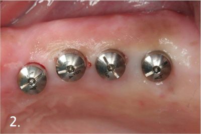 After implant placement. There is almost no bleeding and suture