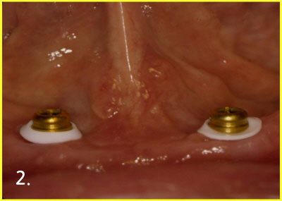 Engaging attachment to implant