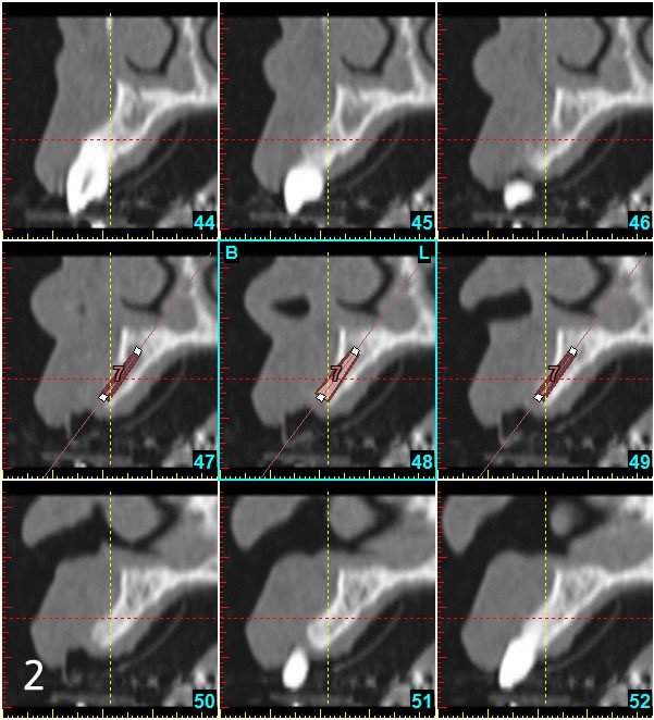 Taking 3D dental CT to evaluate the necessary of bone graft and figure out the amount of bone graft