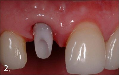 Connecting abutment