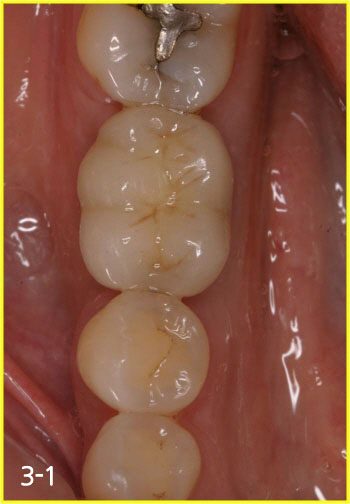 Taking impression and fabricating implant crown 2-3 months after surgery