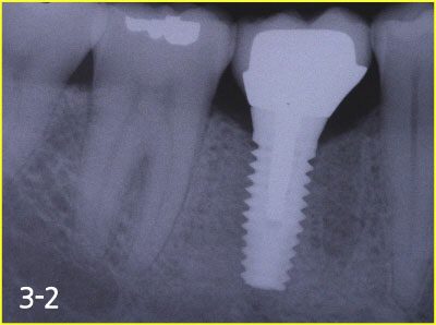 Taking impression and fabricating implant crown 2-3 months after surgery