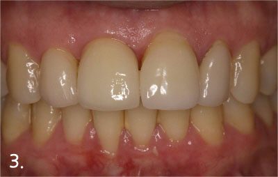 Cementation of implant crown to begin functio