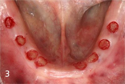 Removal of gum at exact site for implant placement with dental laser