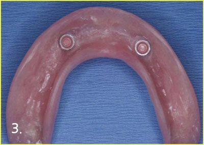 Engaging attachment inside denture