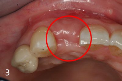Performing implant placement and bone graft