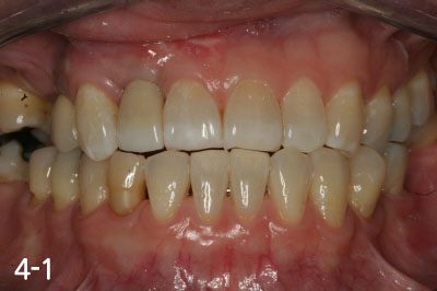 Implant crown is fabricated after successful bone graft and implant placement