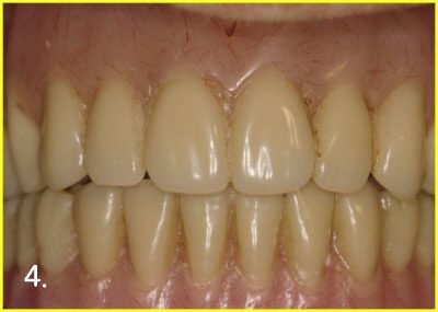 After engaging attachment with implant and denture. Now, patient can feel comfortable with denture much more than before