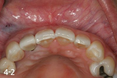 Implant crown is fabricated after successful bone graft and implant placement