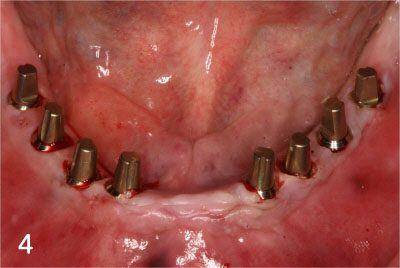 Placing Implants