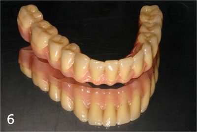 Provisional bridge to use right after placing implants