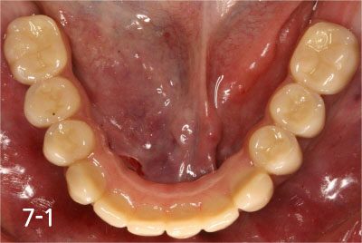 This is after bonding provisional bridge. Patient can have strong teeth in a few hours