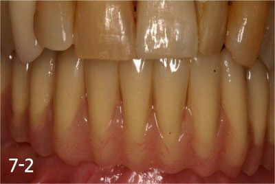 This is after bonding provisional bridge. Patient can have strong teeth in a few hours