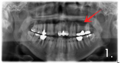 There is not enough bone to place implant on upper and left side.