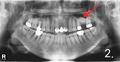 Performed sinus graft more than 90% of bone required to place implant