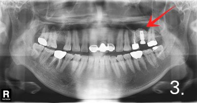 Placing implant in bone graft site
