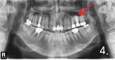 Implant crown was fabricated