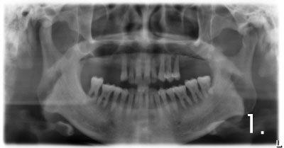 Before the surgery. There is not enough bone at back site to place implants