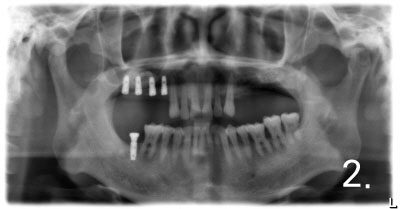 Implant placement and sinus bone graft were performed simultaneously on right side. Only sinus bone graft was performed on left side due to the lack of the residual bone to place implant simultaneously