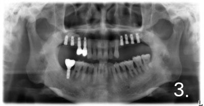 Implant placement was performed a few months after sinus bone graft