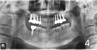 All implant crowns were fabricated and delivered. All teeth functions were restored.