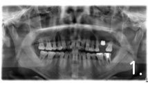 This case is referred from other dental clinic to Dr. Jang due to sinusitis and implant failure. There is basically not enough bone to place implant.