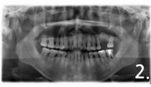 After removal of failed implant and treatment for maxillary sinusitis, sinus bone graft was performed successfully