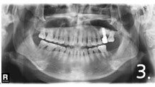 Implant placement and crown fabrication were completed without any complication