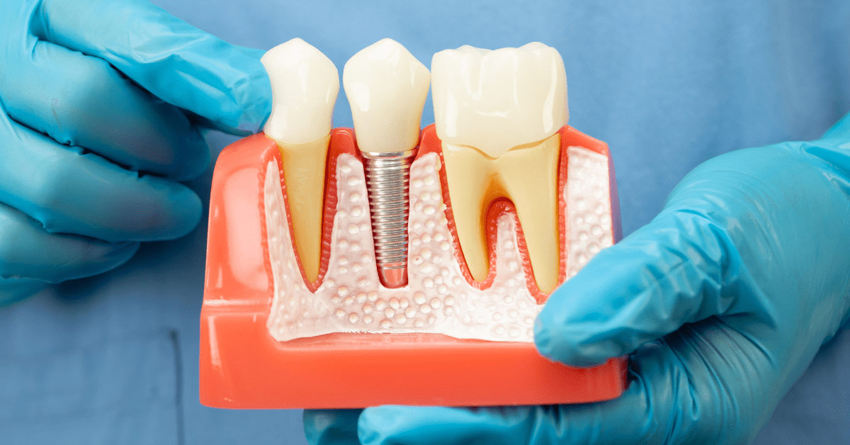 Dental implant model at Sunnyvale Implant Center in San Jose
