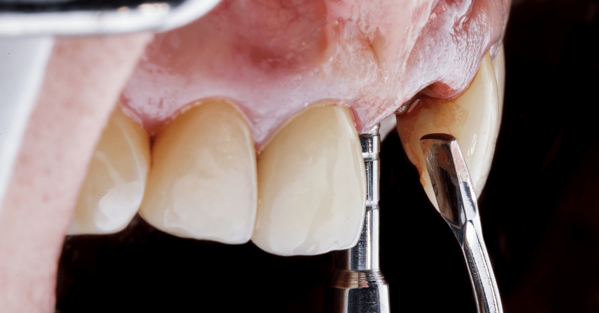 **Short alt text:** Dental implant site with bone grafting procedure