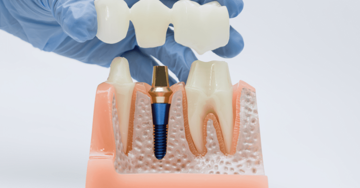 Single tooth dental implant with crown placement illustration