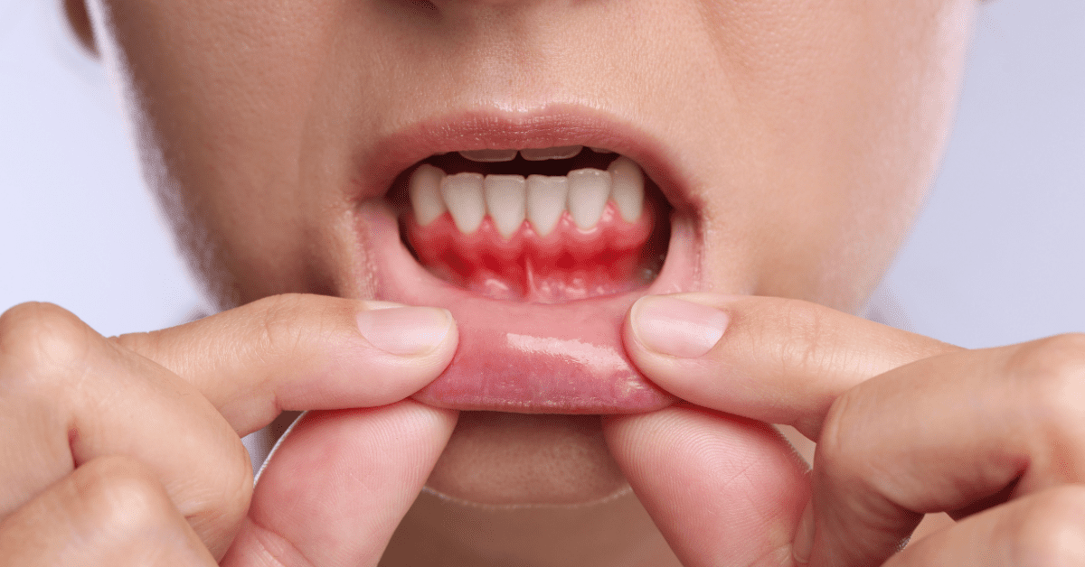 Red and swollen gums along the lower front teeth showing gum inflammation.
