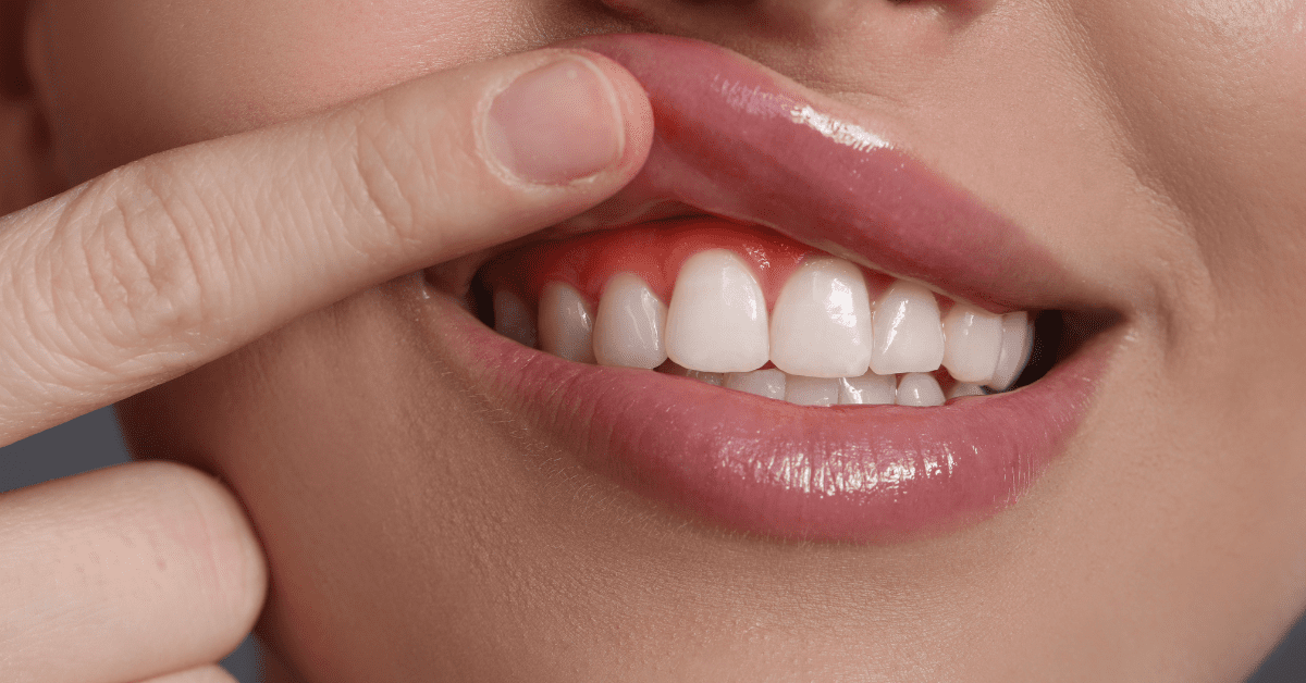 Red and inflamed gums above the front teeth indicating gum disease.