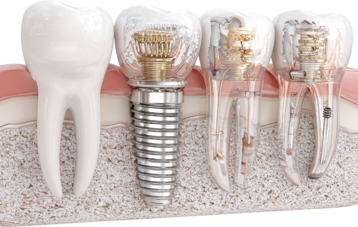 Titanium dental implant and natural tooth comparison at Sunnyvale Implant Center in San Jose, CA