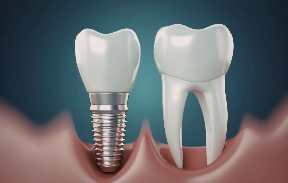 Dental implant and natural tooth comparison at Sunnyvale Implant Center in San Jose, CA
