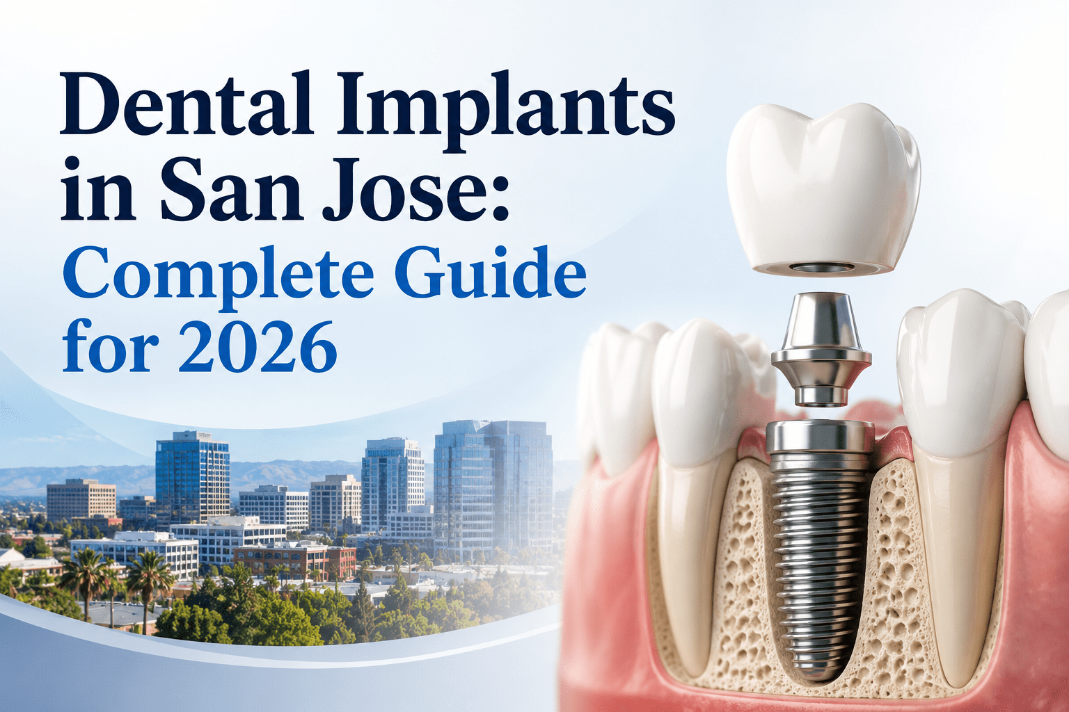 Dental implant illustration with San Jose skyline and 2026 guide title.