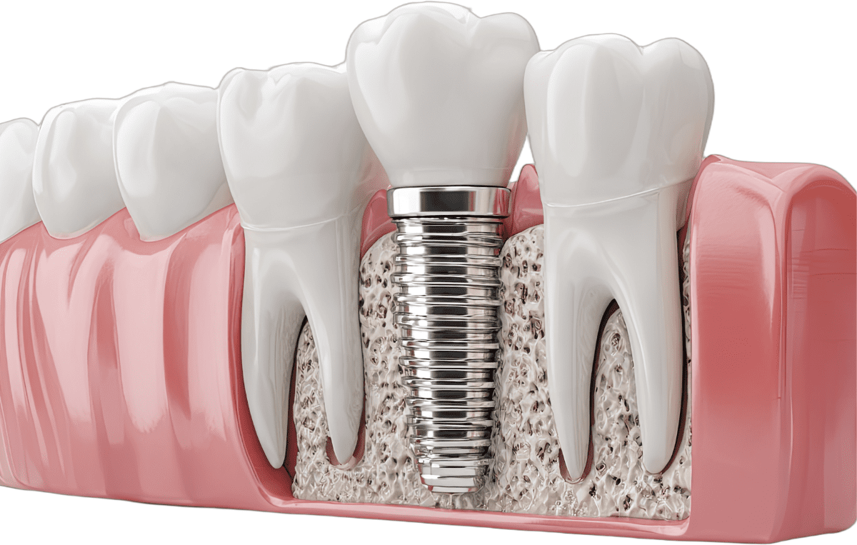 Dental implant with crown placed between natural teeth in the jawbone.